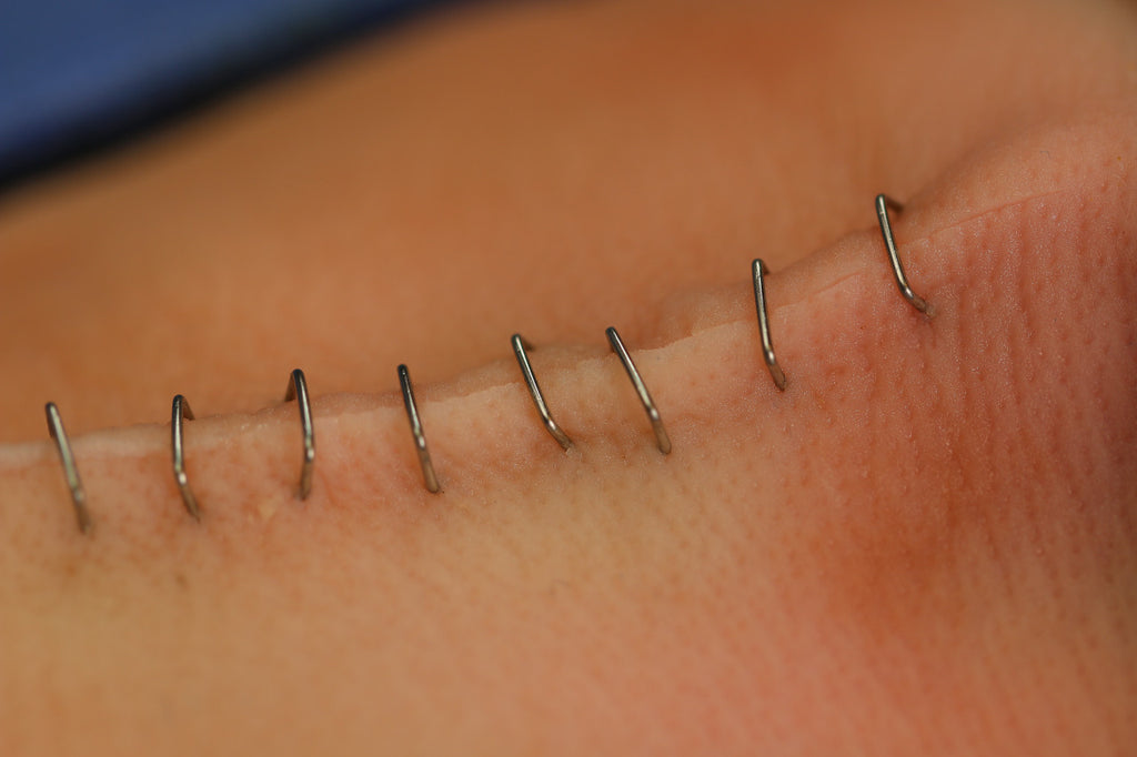 Staples in place