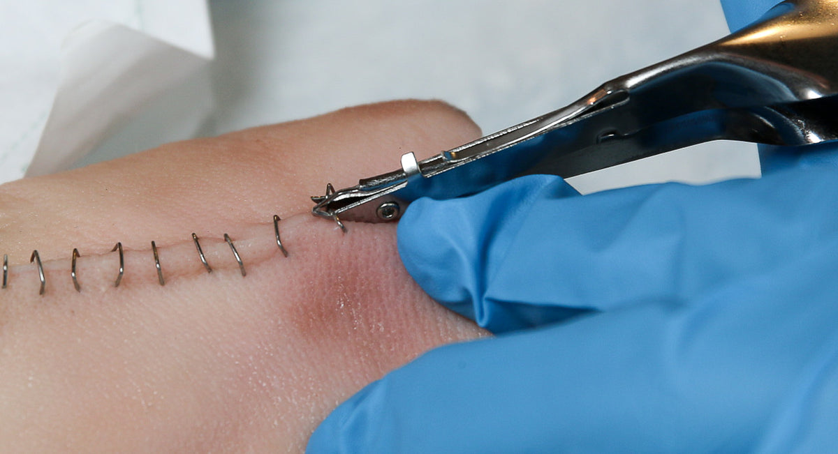 Skin Staple Remover