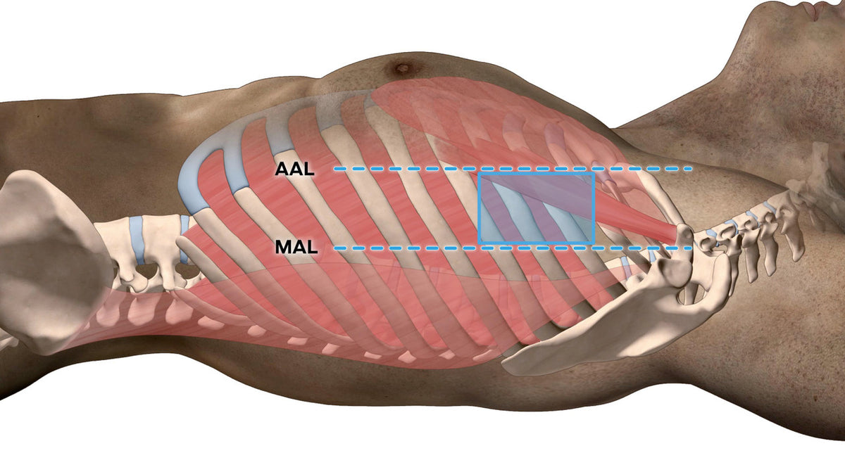 SAM Thorasite decompression needle template insertion anatomy window