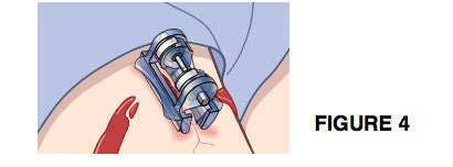 Placing an iTClamp