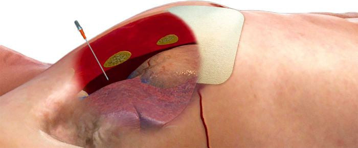 Proper insertion fro decompression needle insertion.